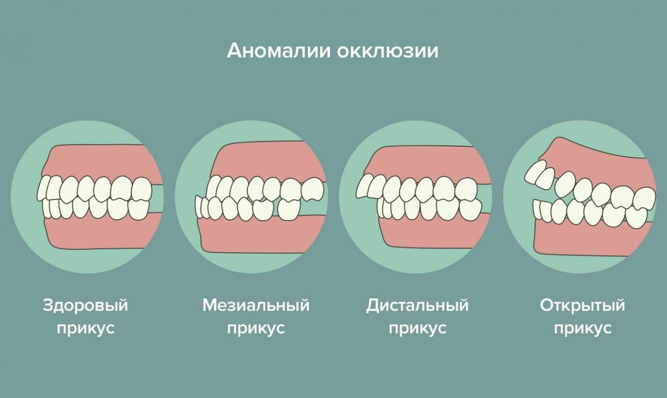 Виды неправильного. Правильный прикус у человека схема сбоку. Правильный прикус зубов у человека схема. Аномалии прикуса глубокий прикус дистальный. Прикус зубов правильный и неправильный.