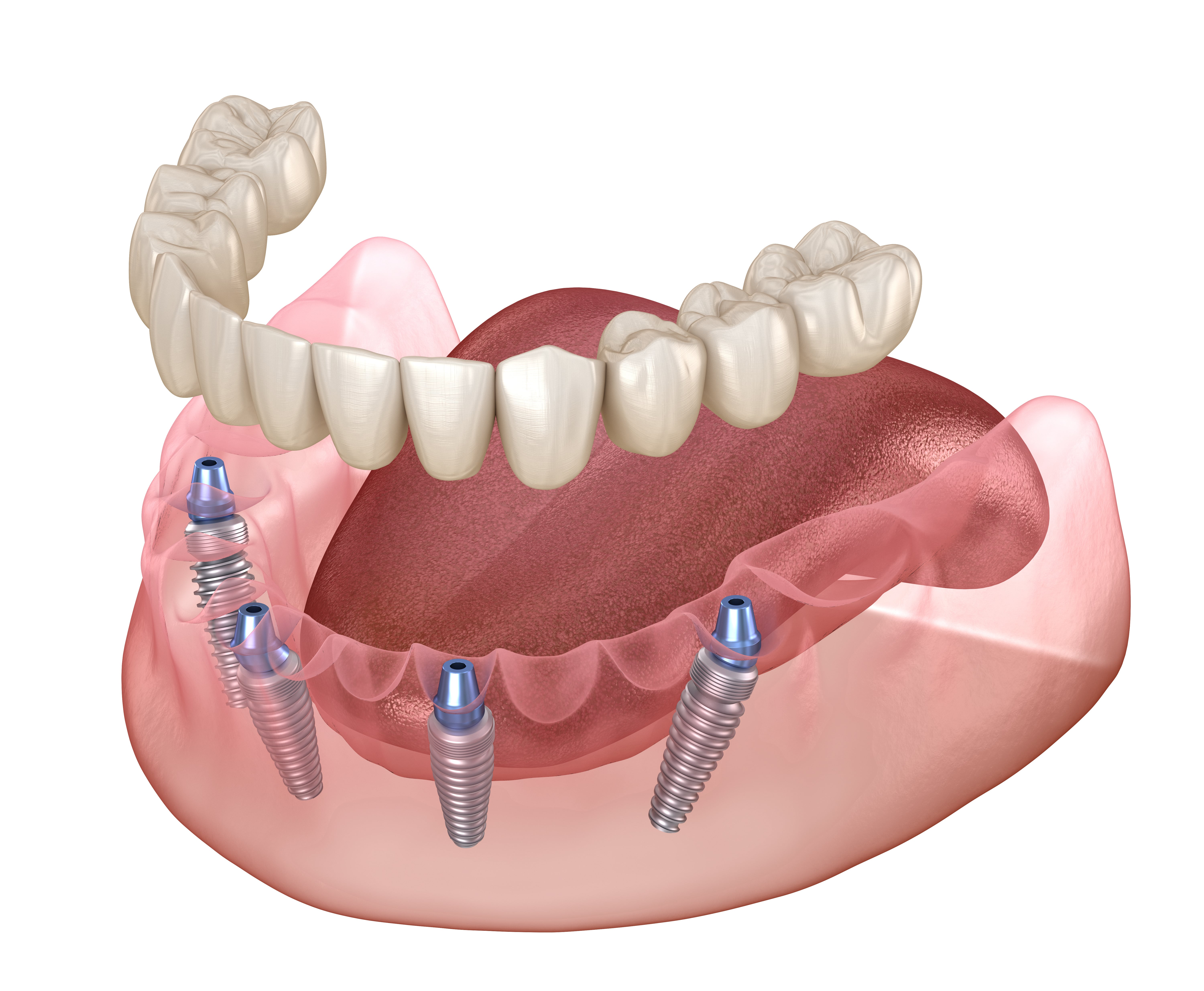 Имплантация зубов all on 6. All on 4 имплантация Нобель. Имплантация зубов по технологии «all on 4» верхней.