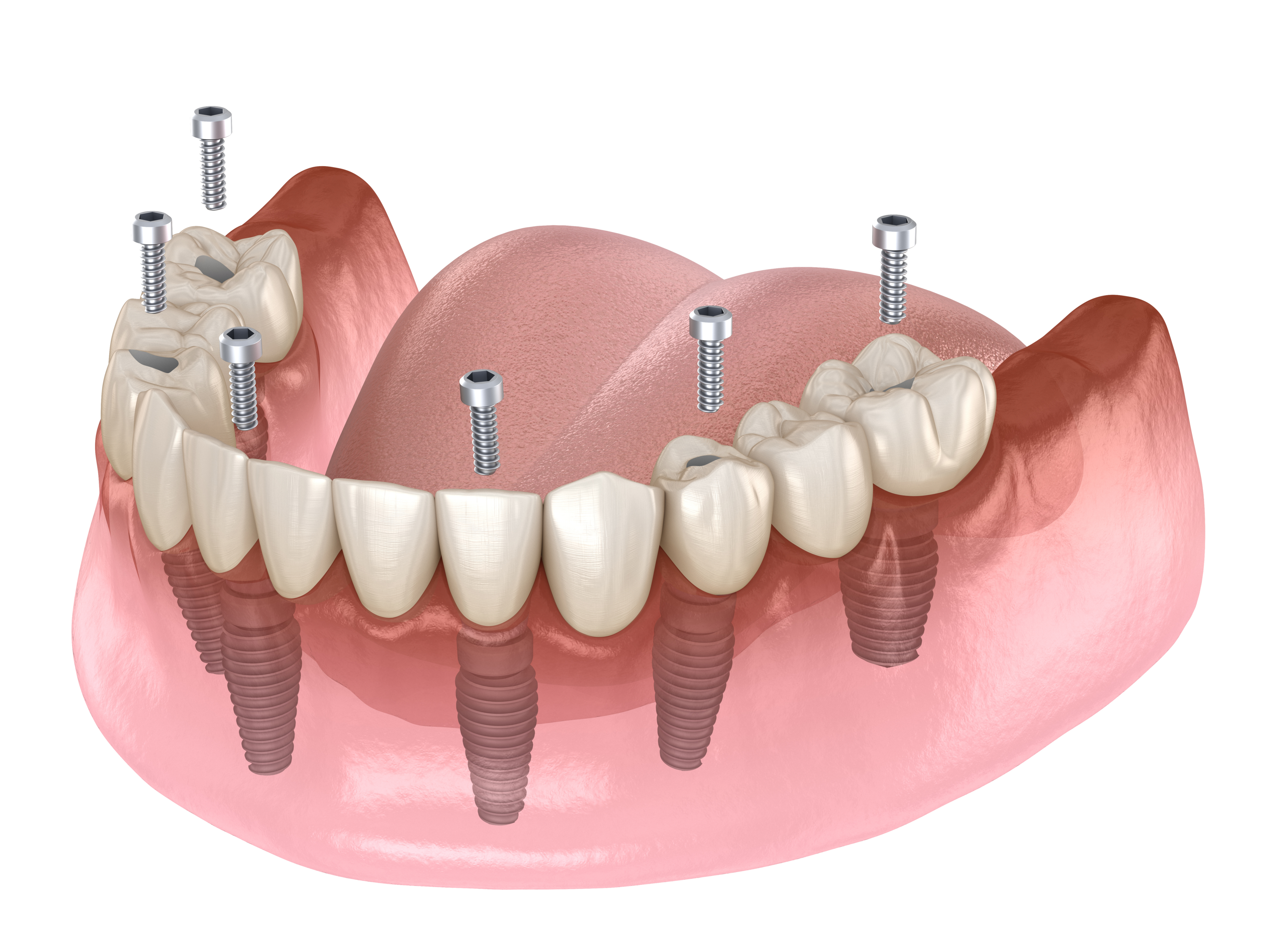 Протез на имплантах при полном отсутствии. Имплантация челюсти на 6 имплантах. Имплантация зубов по технологии «all on 4». Технология имплантации all-on-6.
