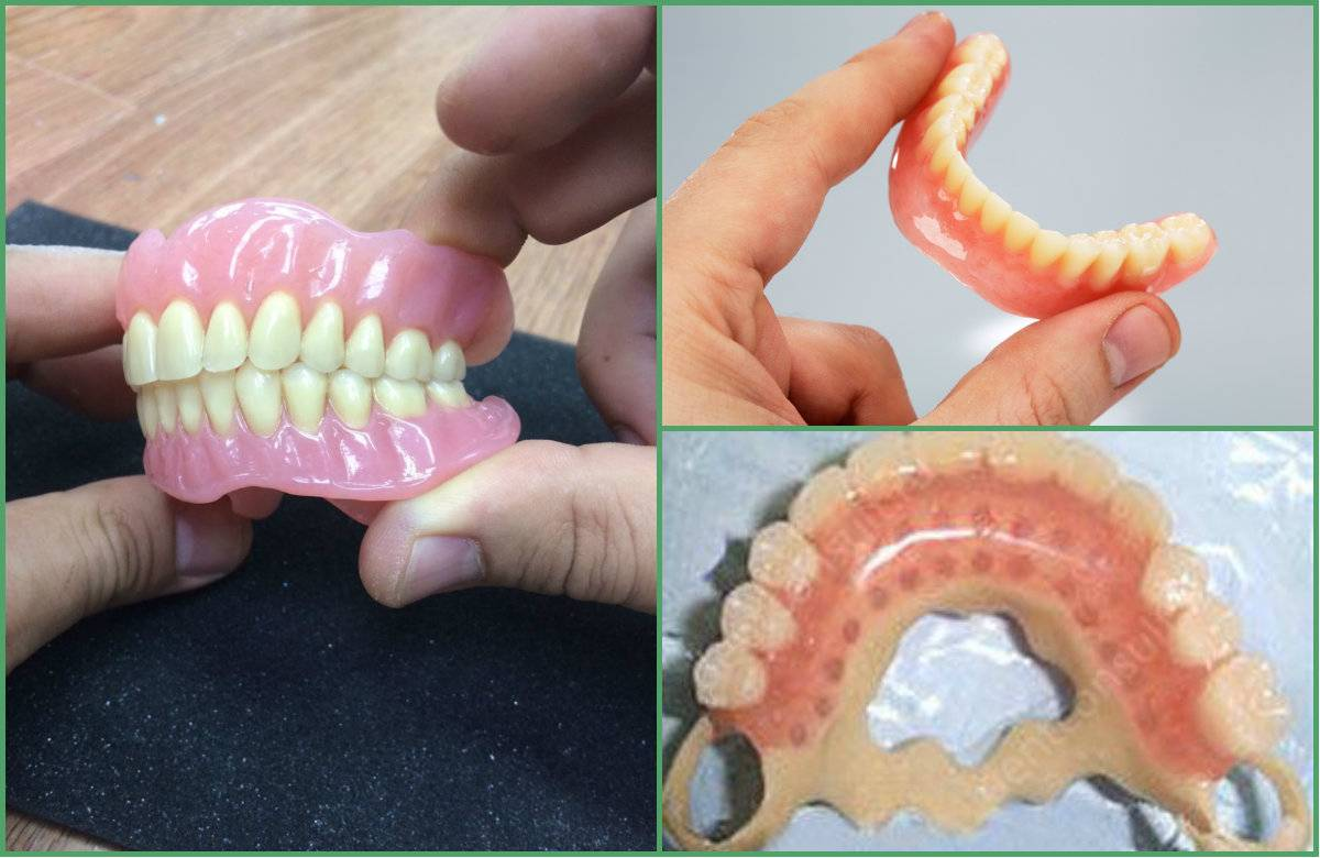 Съемный протез (6-14 зубов) термо Джет. Нейлоновый микропротез 1-3 зуба. Полносъемные протезы ортопедическая стоматология.